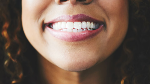 Restylane® Lip Lines Treatment